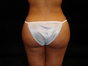 Buttocks Augmentation by Fat Transfer after 186433